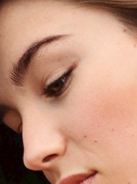 Pele Com Acne