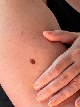 Câncer de pele: dermatologista fala o que é e como prevenir