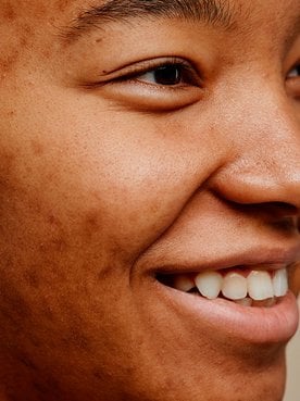 Manchas na pele: descubra quais são os tipos e como tratar