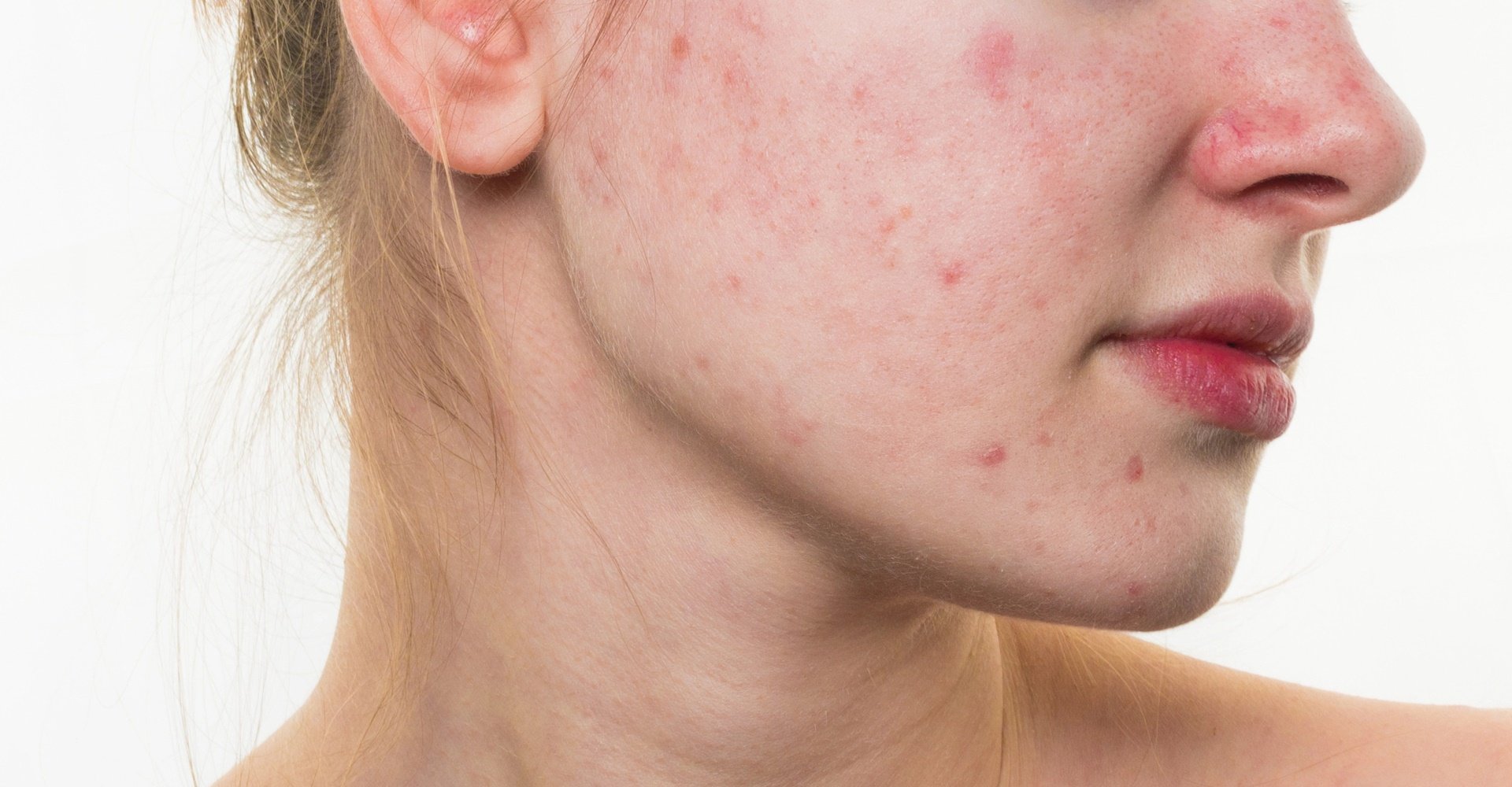 Manchas vermelhas na pele: dermatologista explica o que pode ser e como tratar