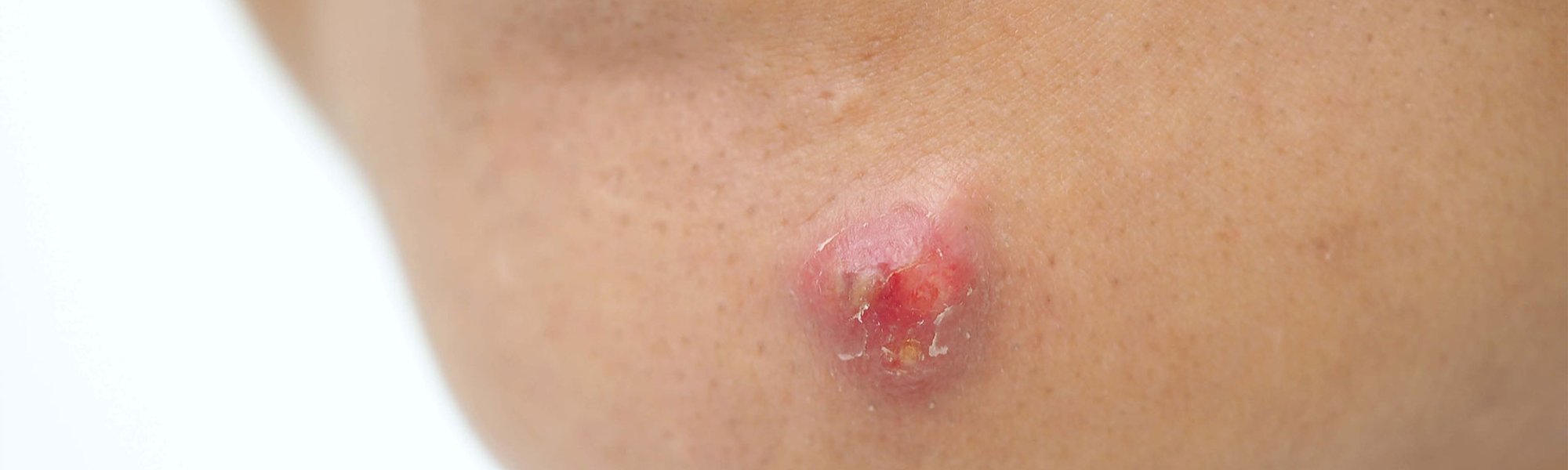 Acne conglobata: dermatologista explica o que causa e como tratar
