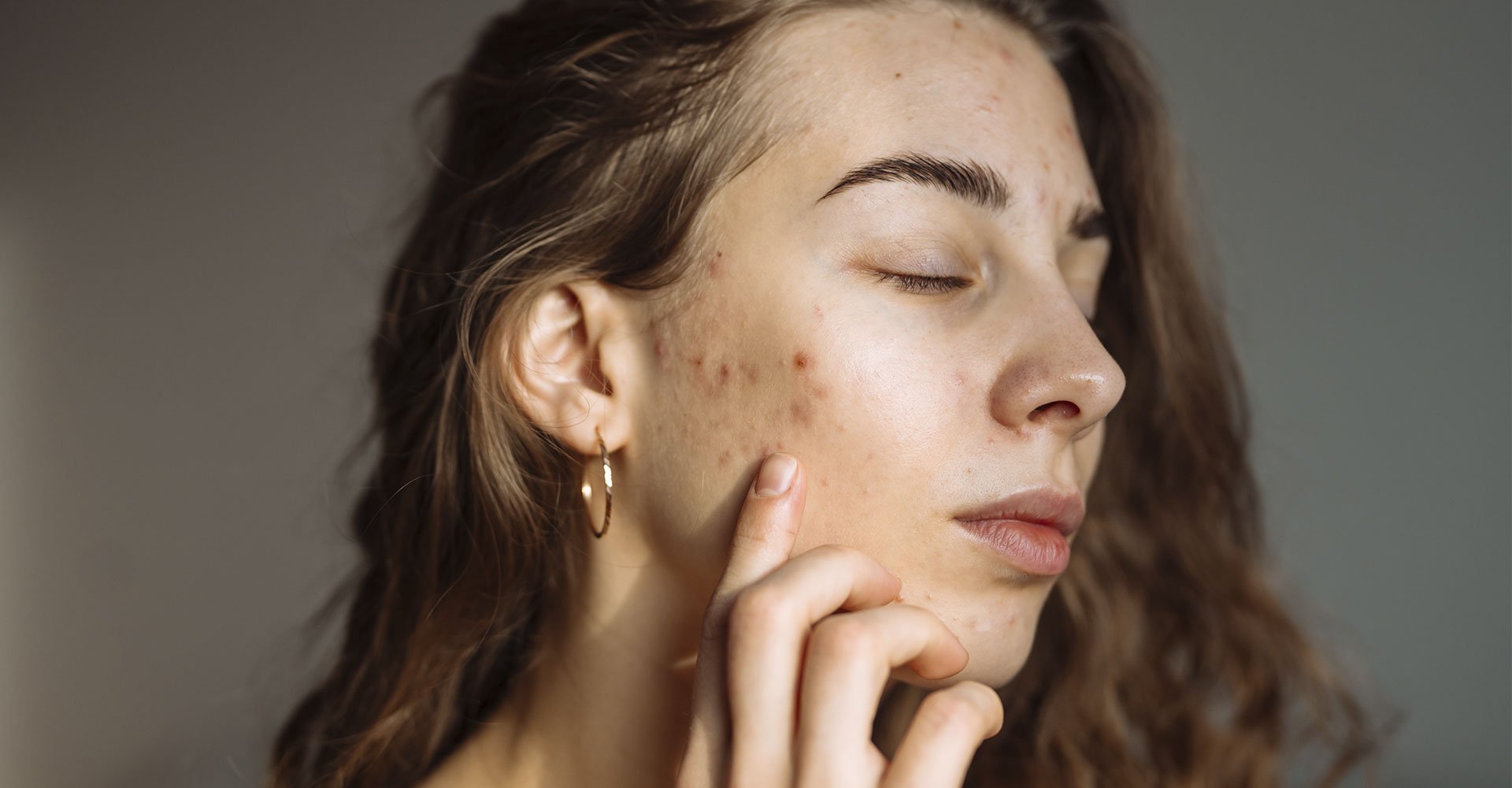 mulher branca com acne no rosto