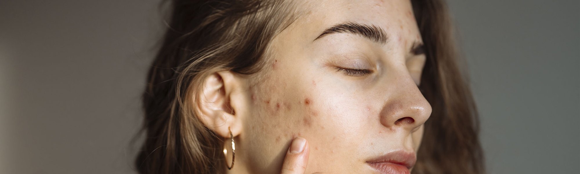 mulher branca com acne no rosto