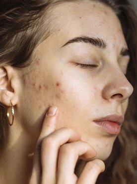 mulher branca com acne no rosto