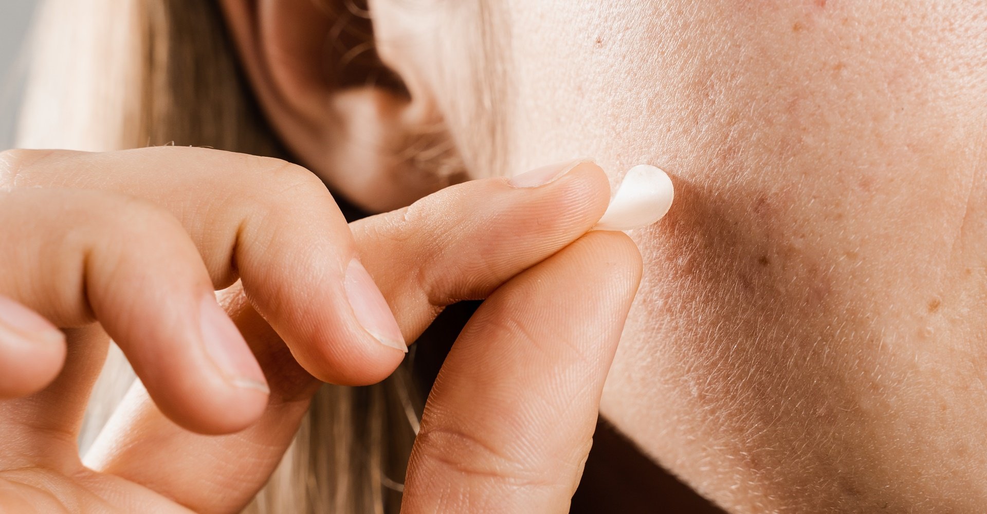 Mulher usa adesivos para espinha para ajudar a tratar as espinhas no rosto