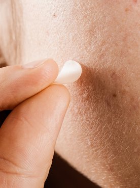 Mulher usa adesivos para espinha para ajudar a tratar as espinhas no rosto