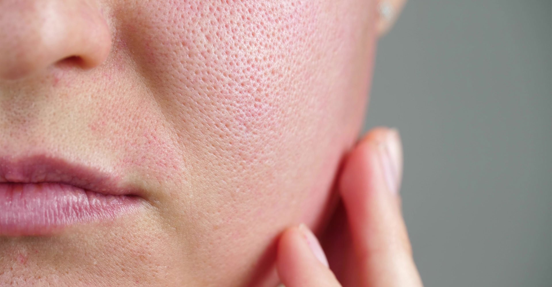 Close-up mostrando poros dilatados na pele da bochecha