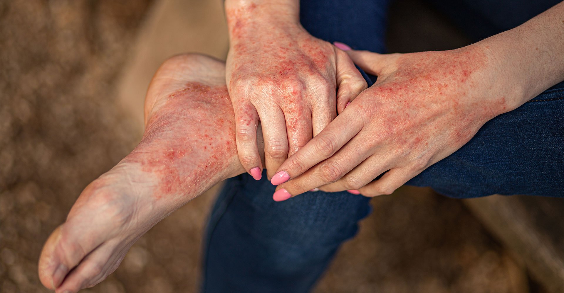 pele das mãos e pé com dermatite atópica