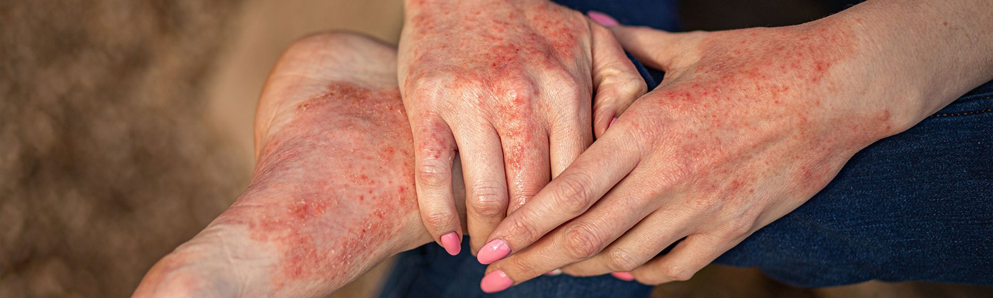 pele das mãos e pé com dermatite atópica