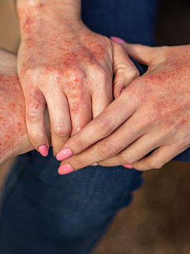 pele das mãos e pé com dermatite atópica