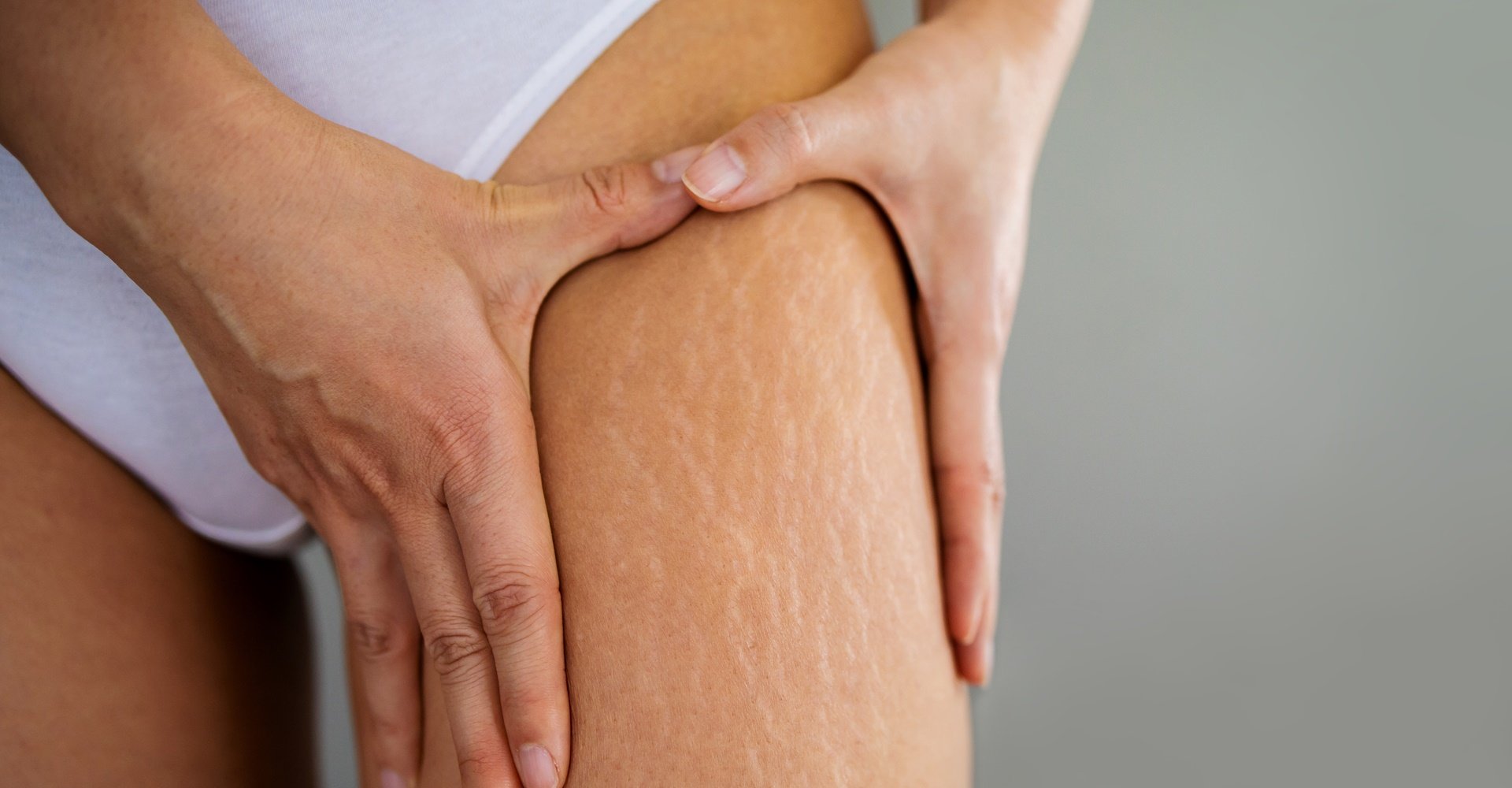 Estrias na perna de uma mulher