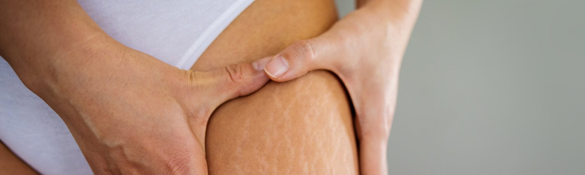 Estrias na perna de uma mulher