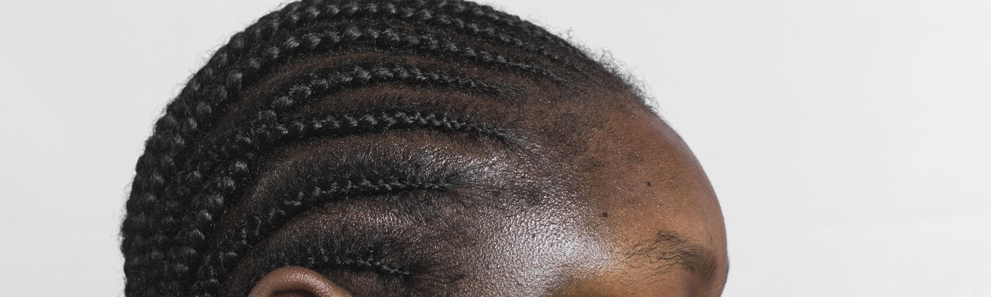 Mulher de perfil com manchas marrons na pele