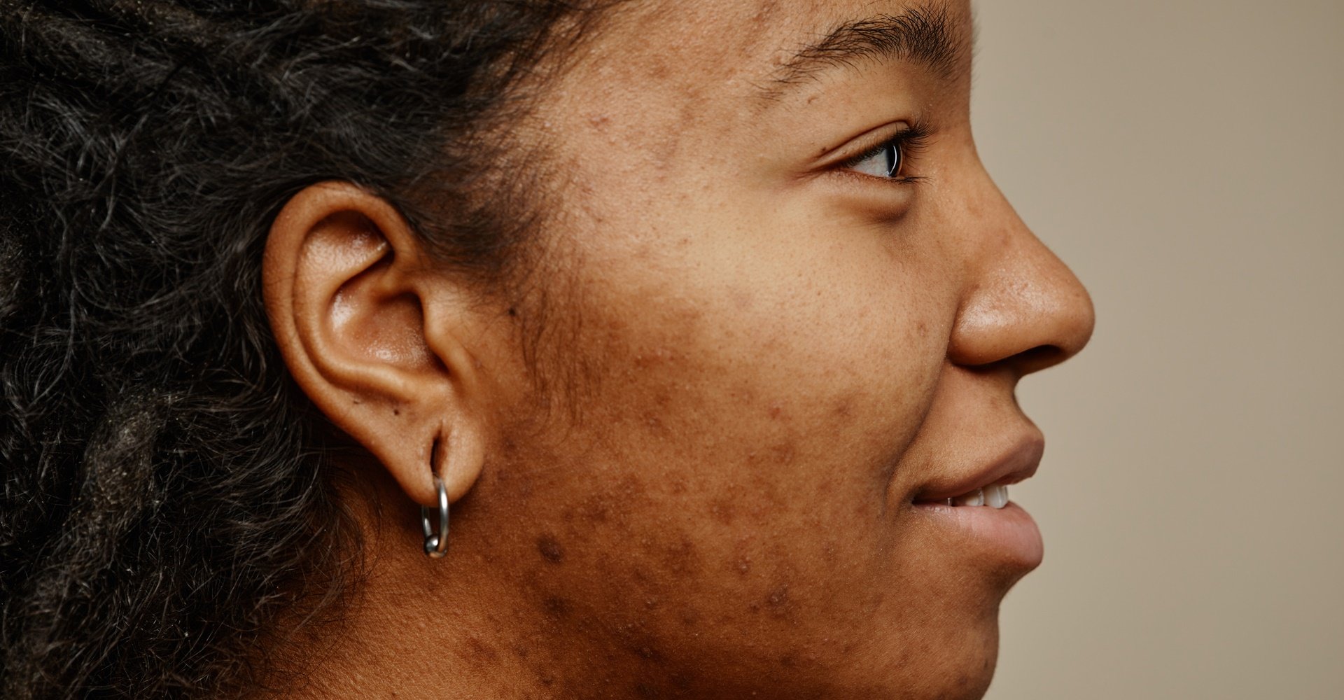 Mulher negra com manchas escuras na pele do rosto