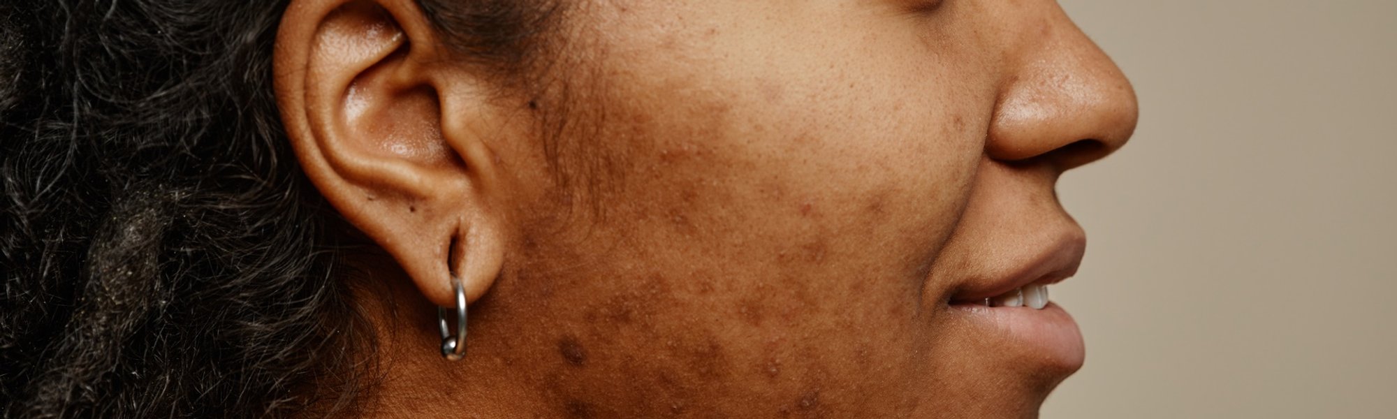 Mulher negra com manchas escuras na pele do rosto
