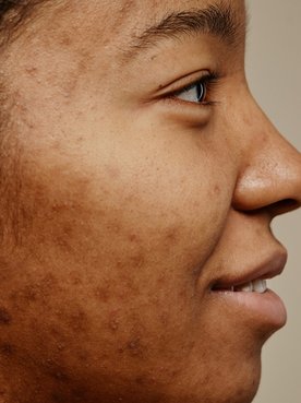 Mulher negra com manchas escuras na pele do rosto