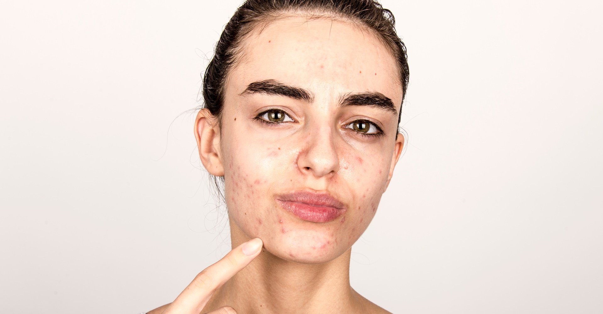 Pele acneica em garota que aponta para seu rosto com a pele com acne