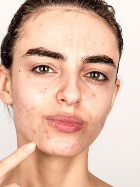 Pele acneica em garota que aponta para seu rosto com a pele com acne