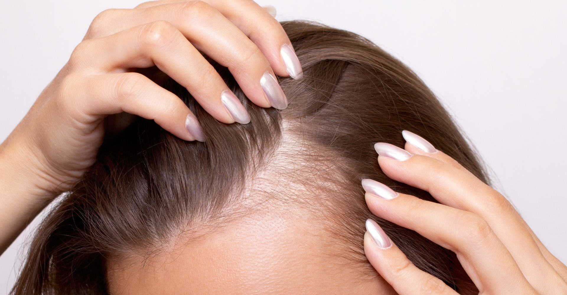 Mulher com unhas grandes com esmalte perolado com as mãos no couro cabeludo que está com alopecia por tração
