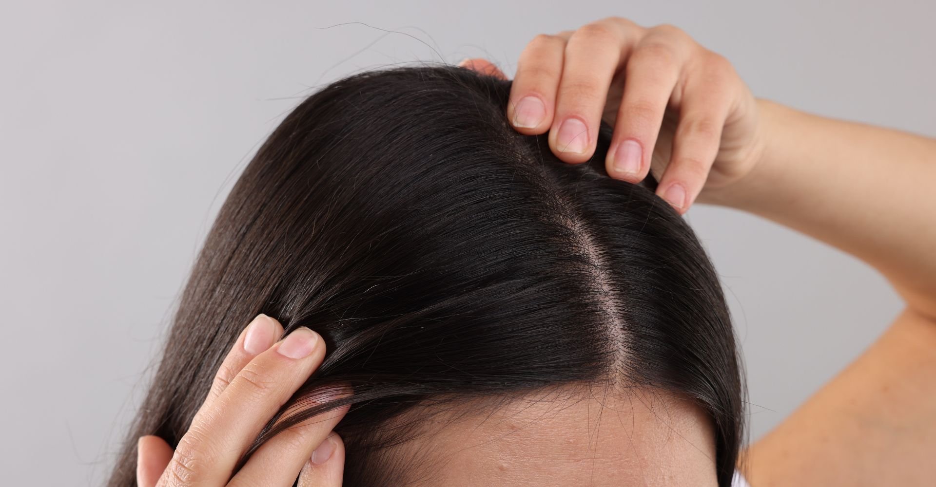 Mulher com as mãos na cabeça procurando os sintomas da foliculite no couro cabeludo.