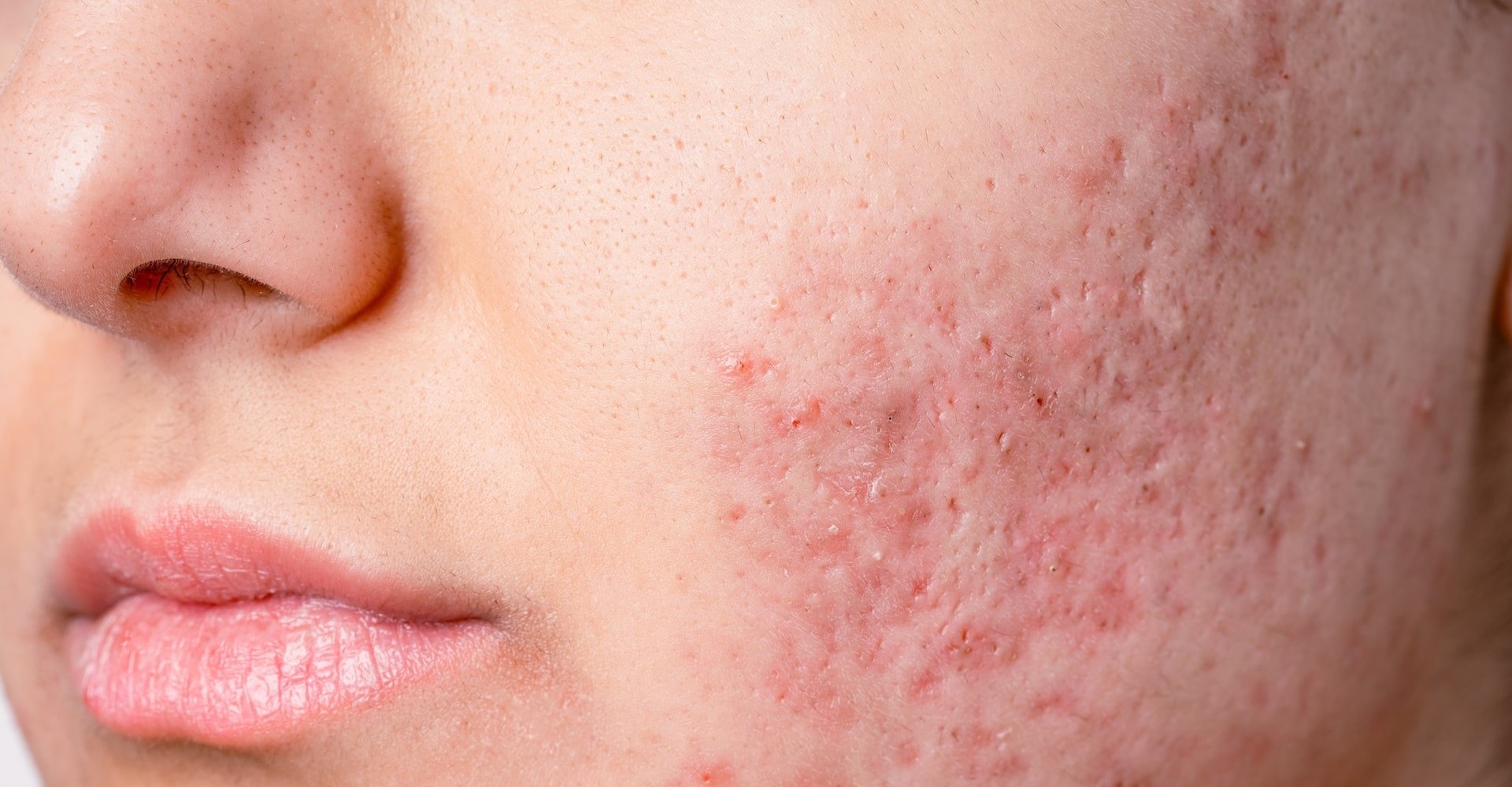Pele do rosto de uma jovem com cicatriz de acne e espinhas