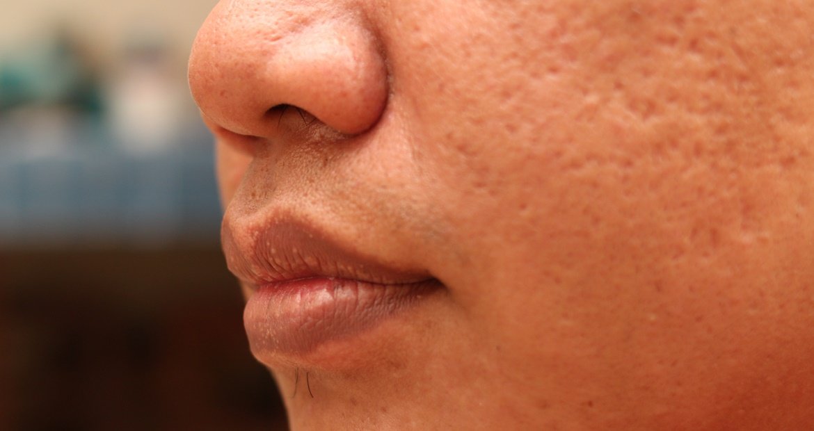Rosto de mulher com cicatrizes atróficas de acne.