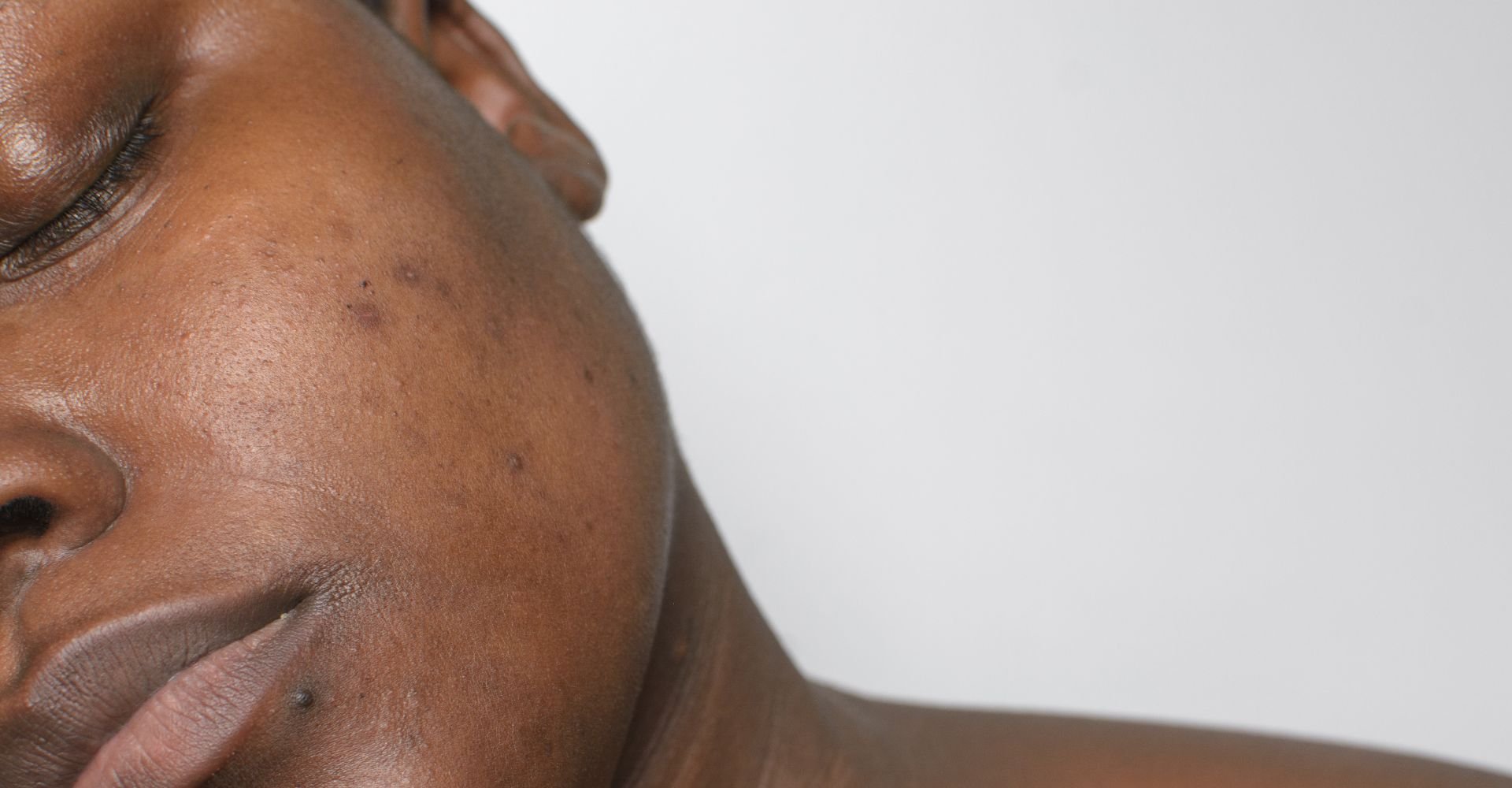 Mulher negra com manchas na pele que podem ser removidas com clareador de manchas