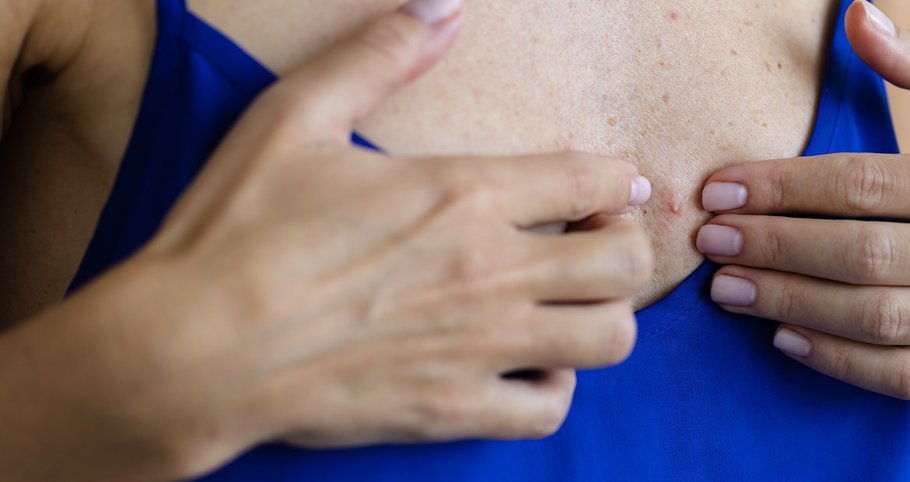 Espinha no peito: entenda as causas e trate corretamente
