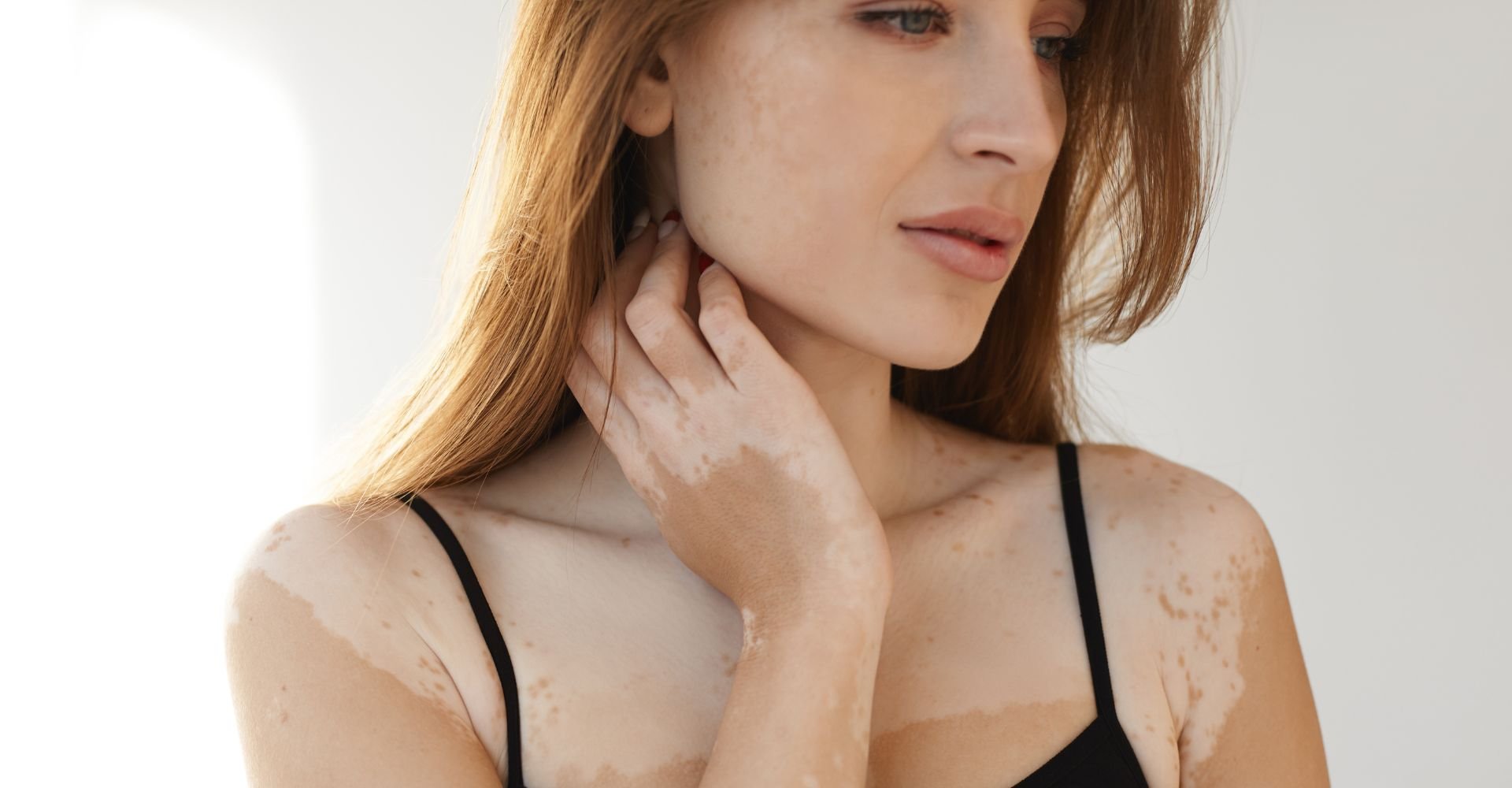 Jovem mulher com manchas brancas no rosto e corpo 