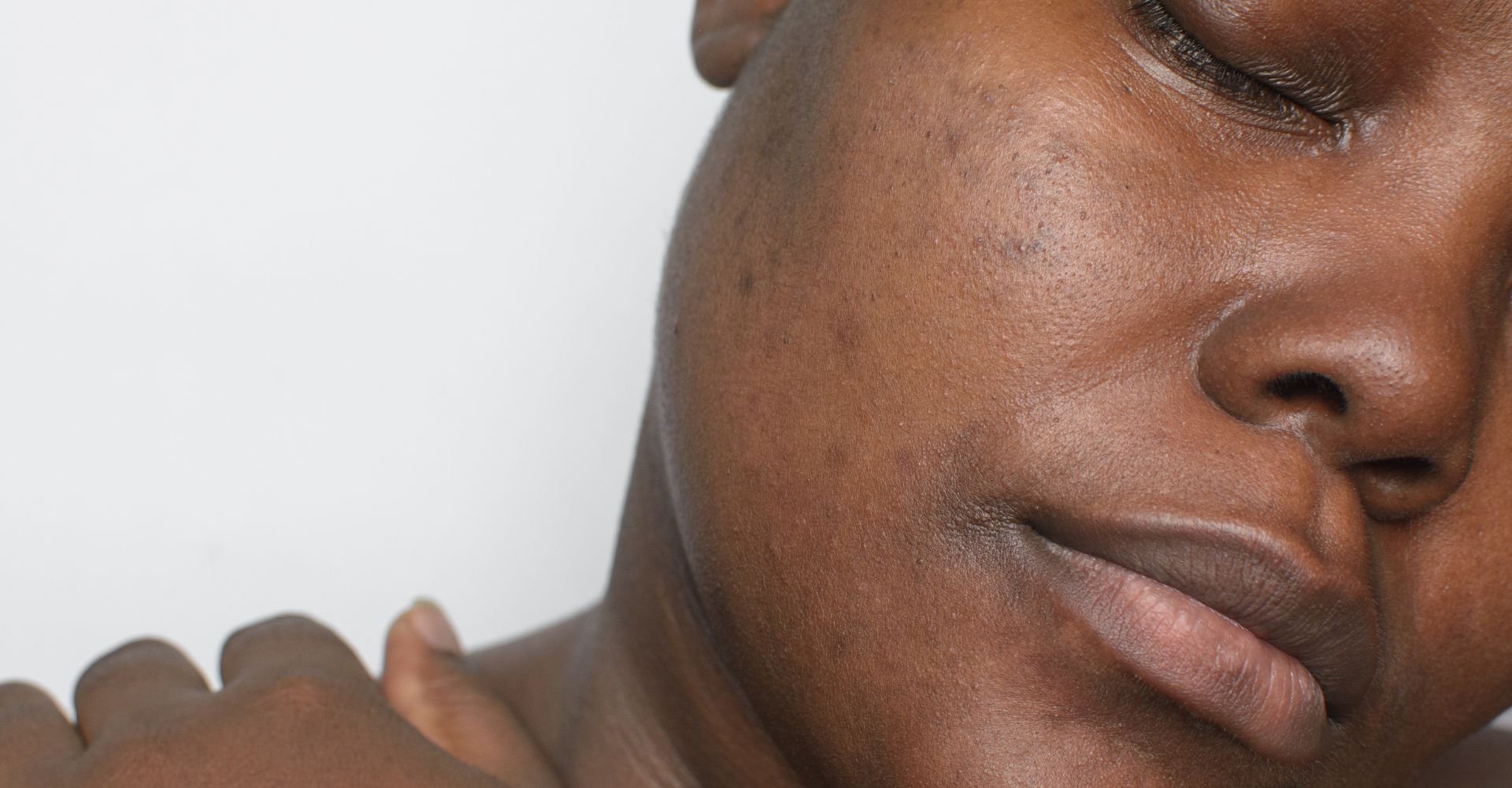 Mulher com olhos fechados e manchas escuras na pele.