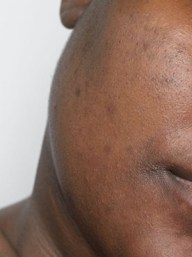 Mulher com olhos fechados e manchas escuras na pele.