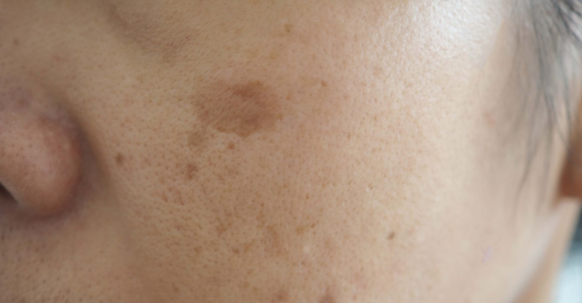 Mulher com muitas manchas no rosto