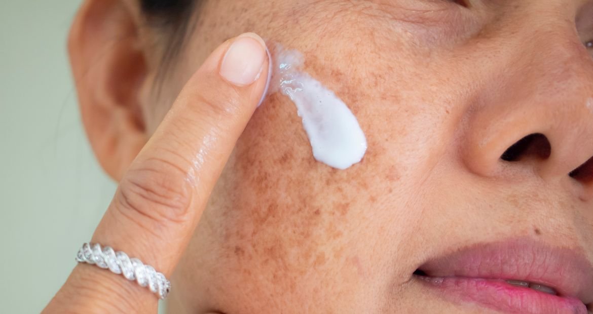 Mulher aplica protetor solar para proteger a pele com manchas no rosto