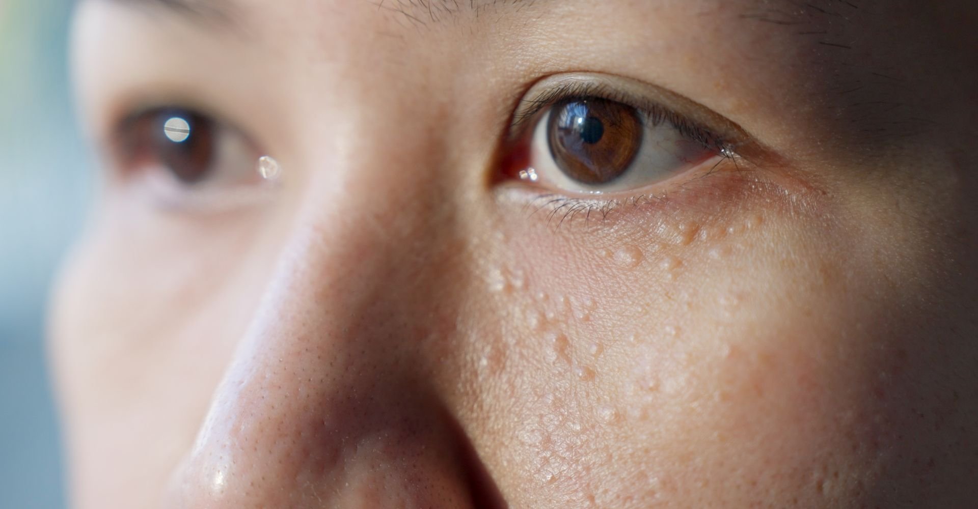 Região dos olhos e nariz de uma mulher com milium no rosto 