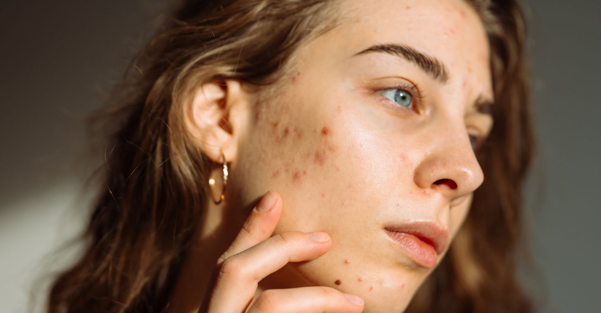 Menina loira com a mão no rosto manchado.