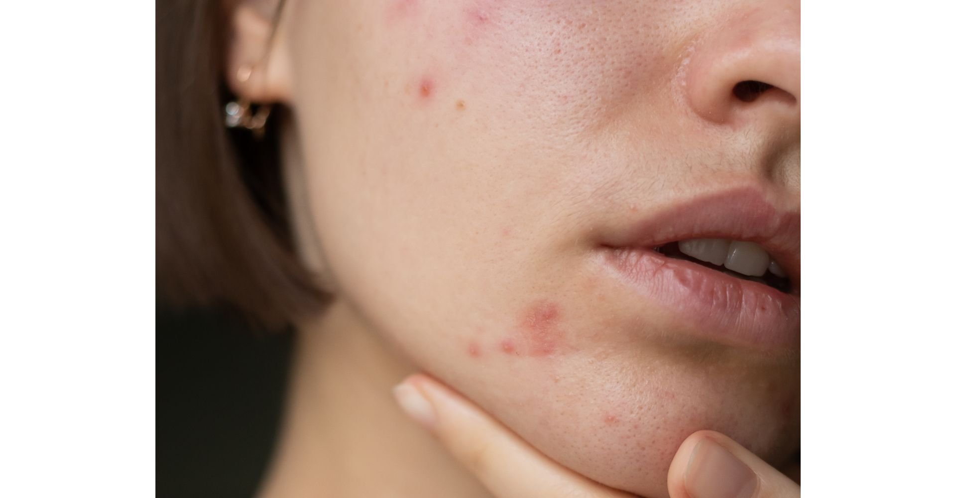 Mulher conferindo manchas de espinha no rosto