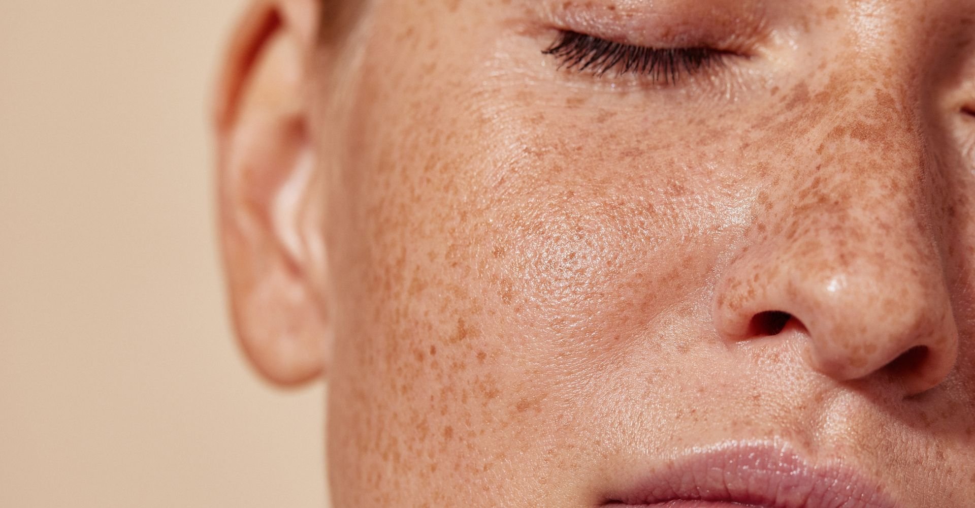 Close-up de mulher com manchas solares visíveis (hiperpigmentação) nas bochechas e ao redor dos olhos.