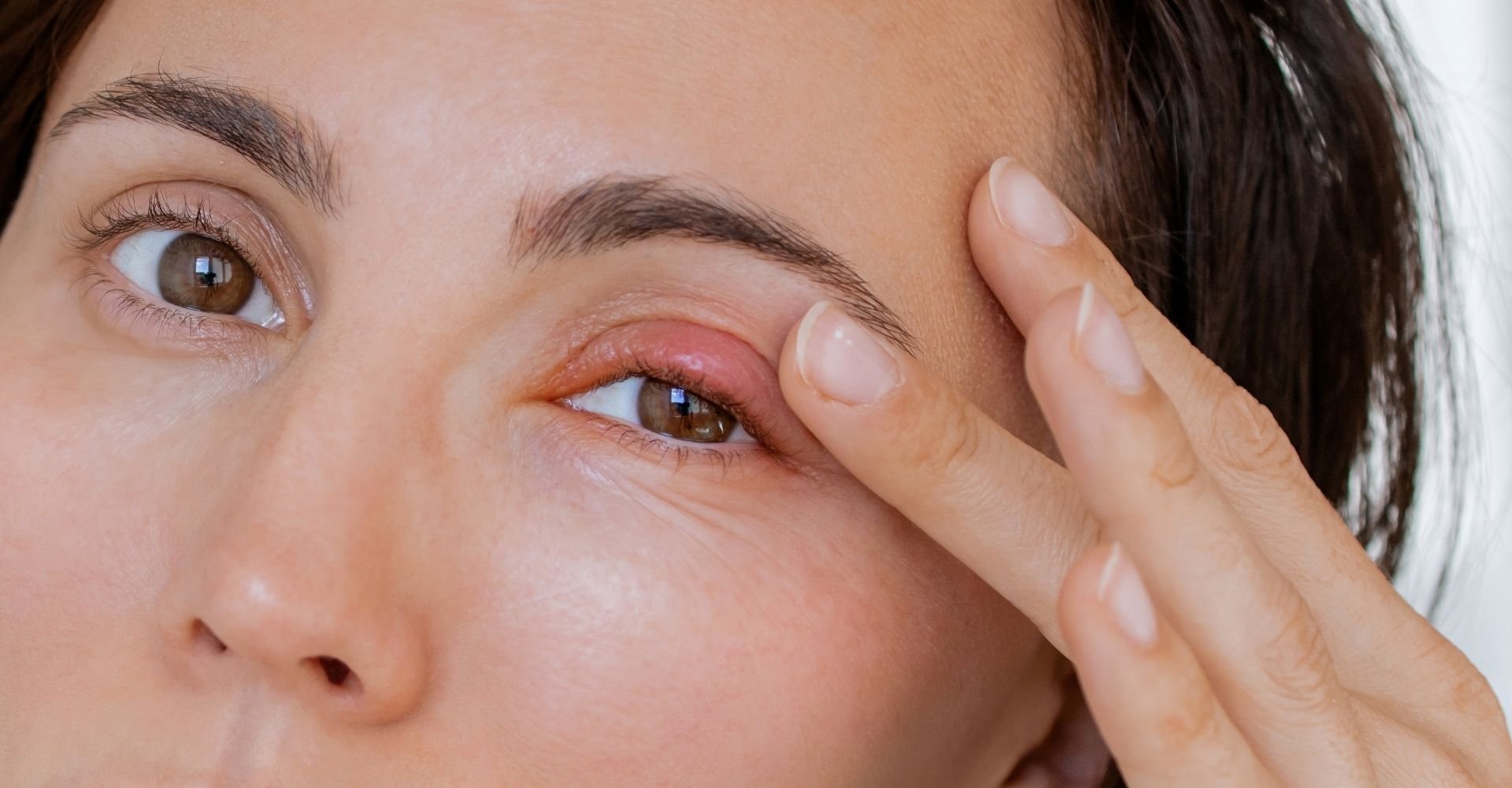 Olho Inchado Avermelhado