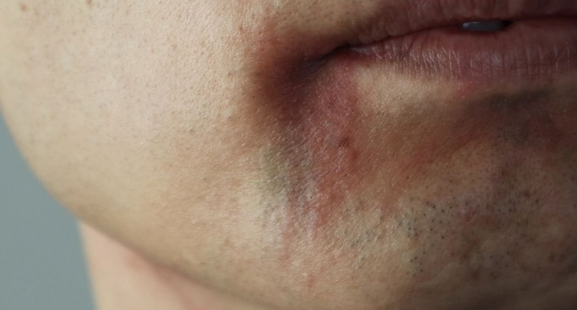 Homem com pele irritada ao lado dos lábios após depilação com lâmina.