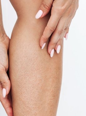 Mulher com as mãos em sua panturrilha que está com a pele irritada após depilação.