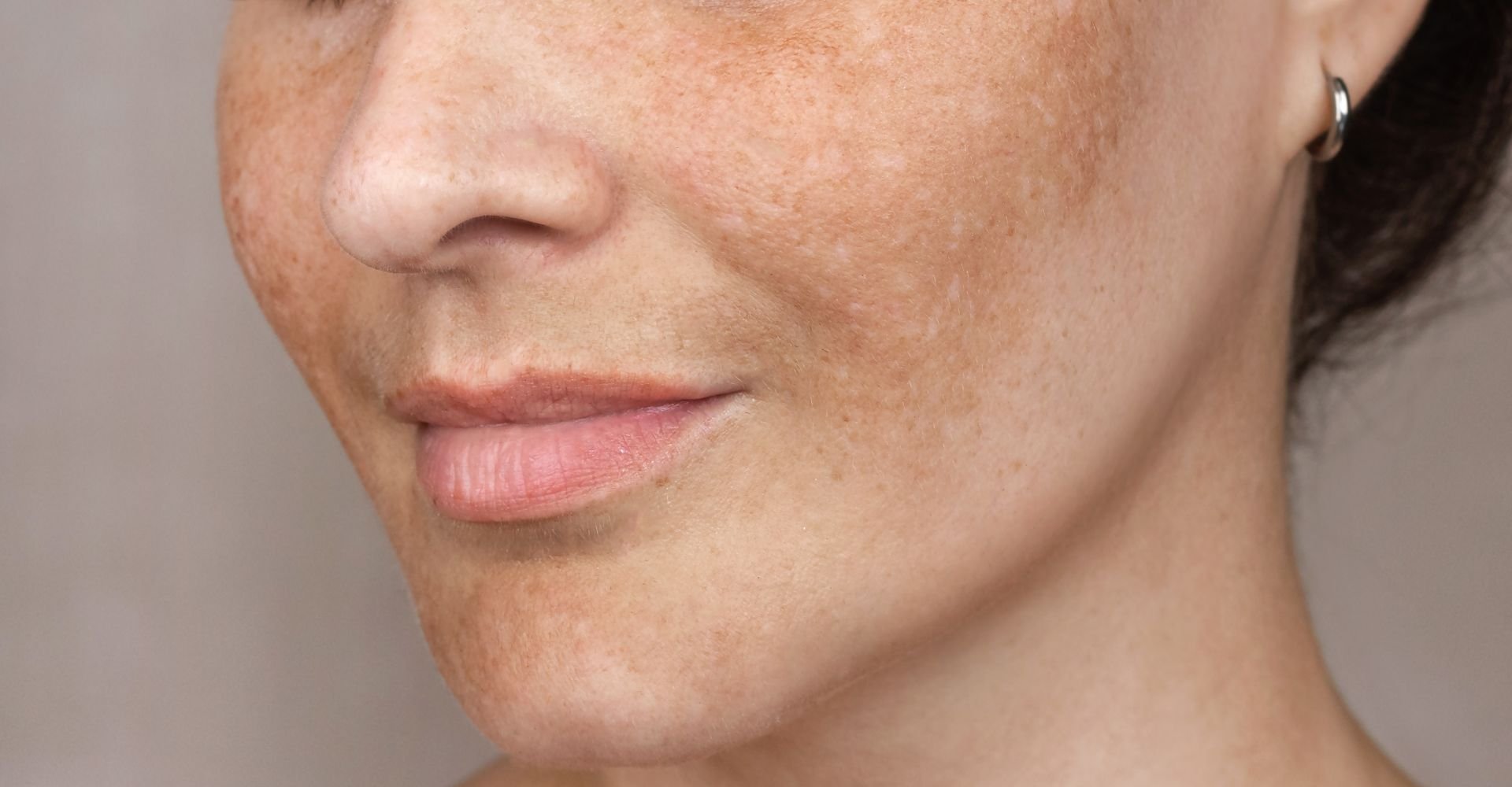 Metade inferior do rosto de uma mulher sorrindo, exibindo as manchas de sol em sua pele.