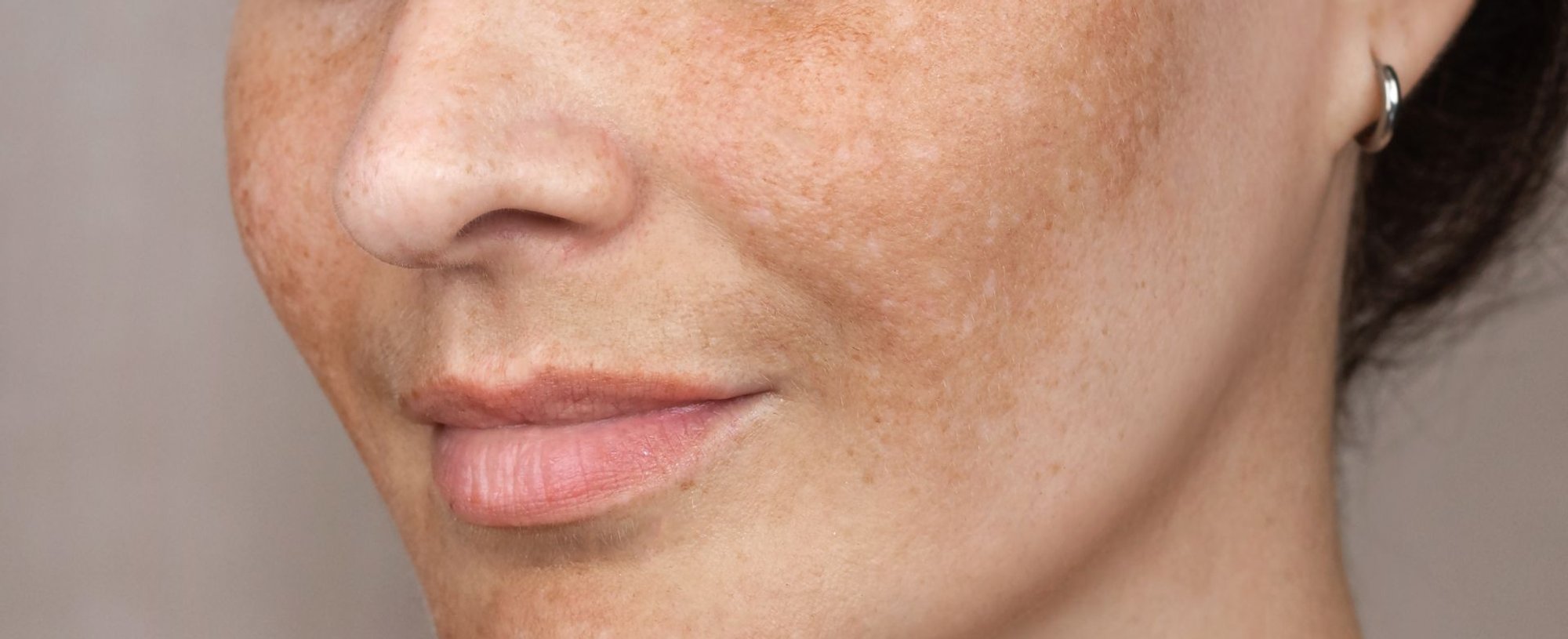 Metade inferior do rosto de uma mulher sorrindo, exibindo as manchas de sol em sua pele.