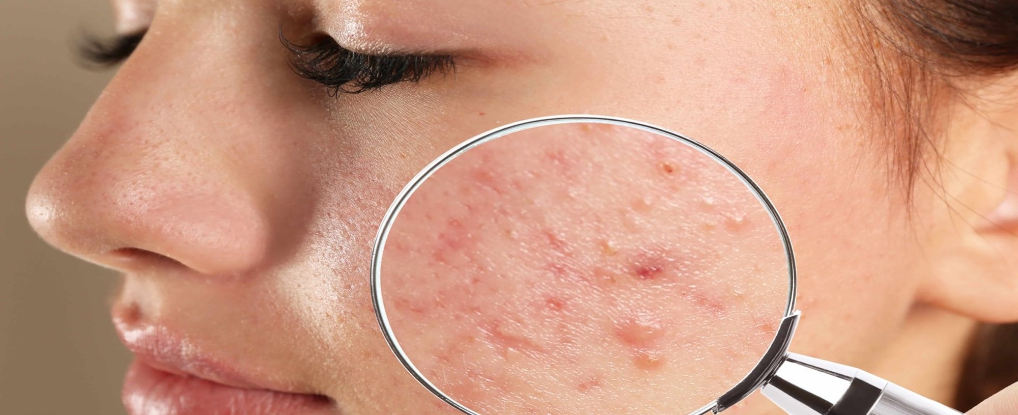 Imagem De Um Rosto Com Manchas De Acne