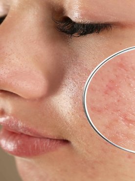 Imagem De Um Rosto Com Manchas De Acne