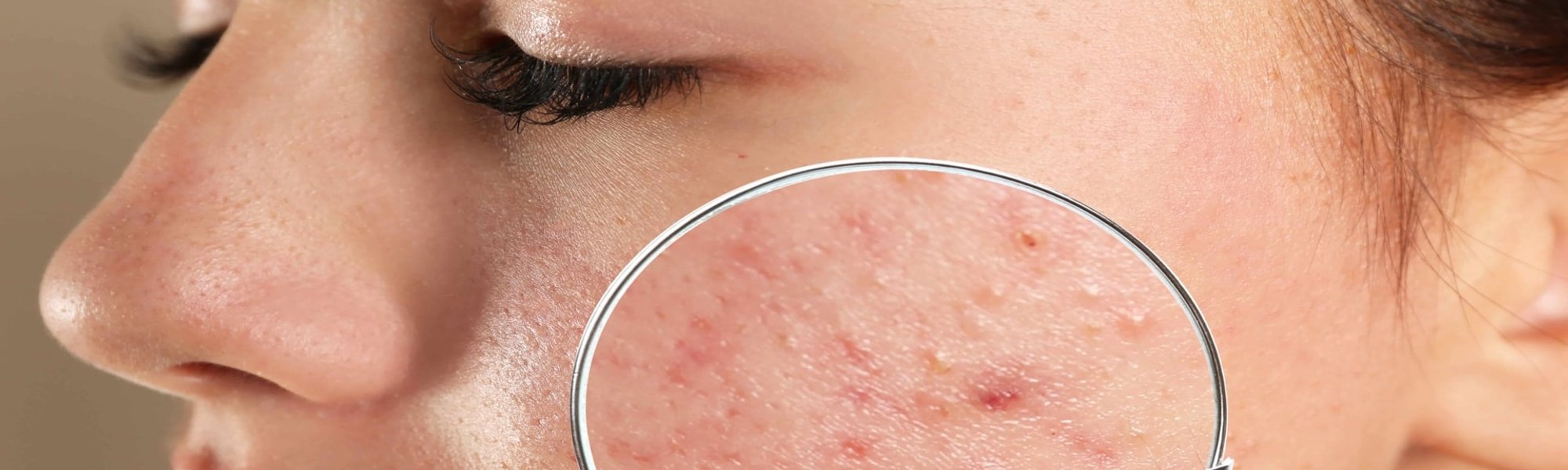 Saiba como tratar a espinha interna inflamada no rosto | L'Oréal Paris