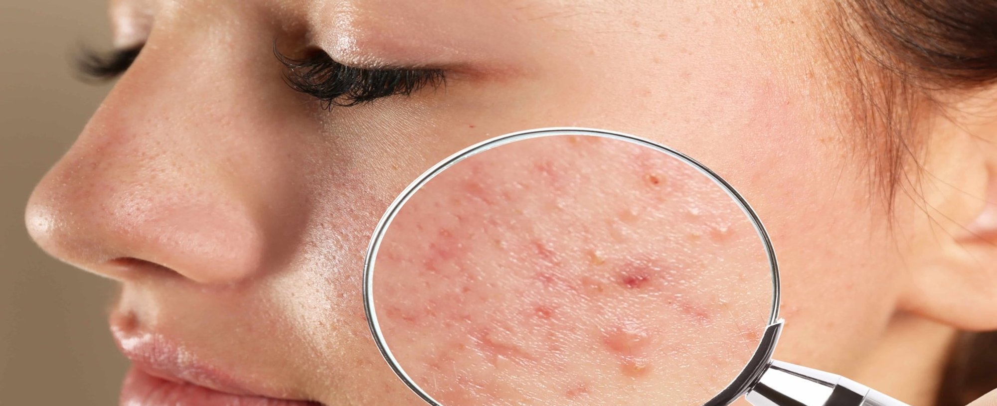 Imagem De Um Rosto Com Manchas De Acne