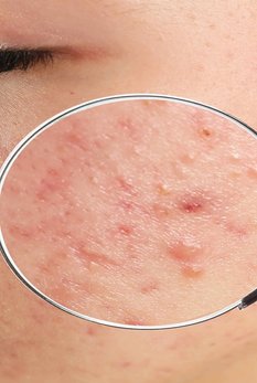 Como saber se minha pele é quente ou fria? Dicas úteis | L'Oréal Paris