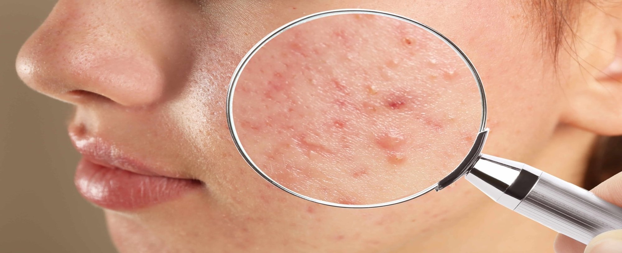 Imagem De Um Rosto Com Manchas De Acne