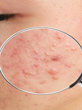 Imagem De Um Rosto Com Manchas De Acne