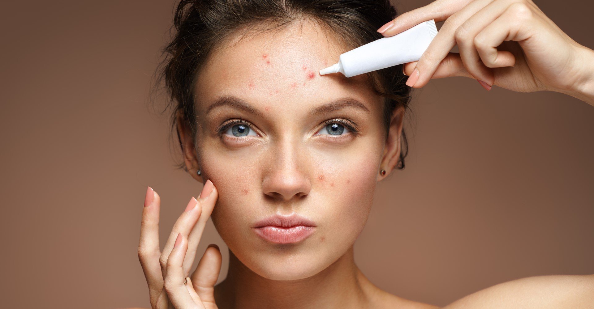 Modelo branca passando produto em acne do rosto